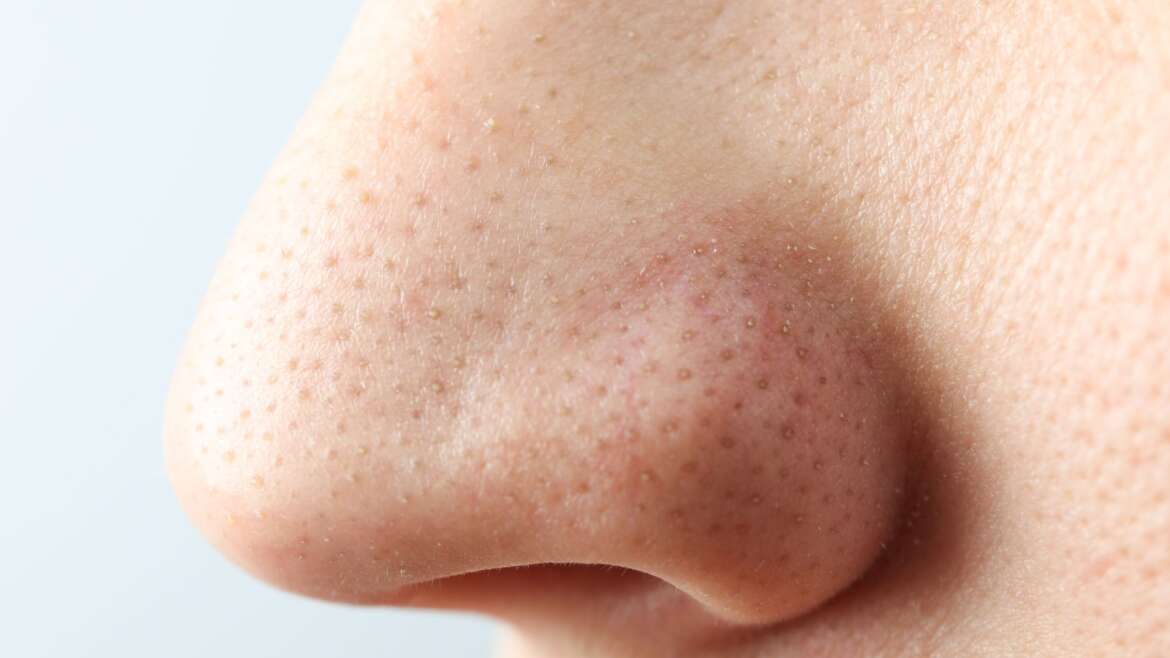 Nose Tip Lift