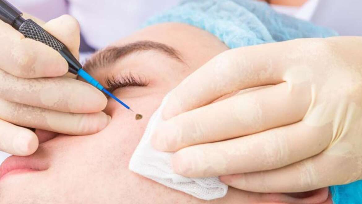 Mole and Skin Tag Removal Consultation