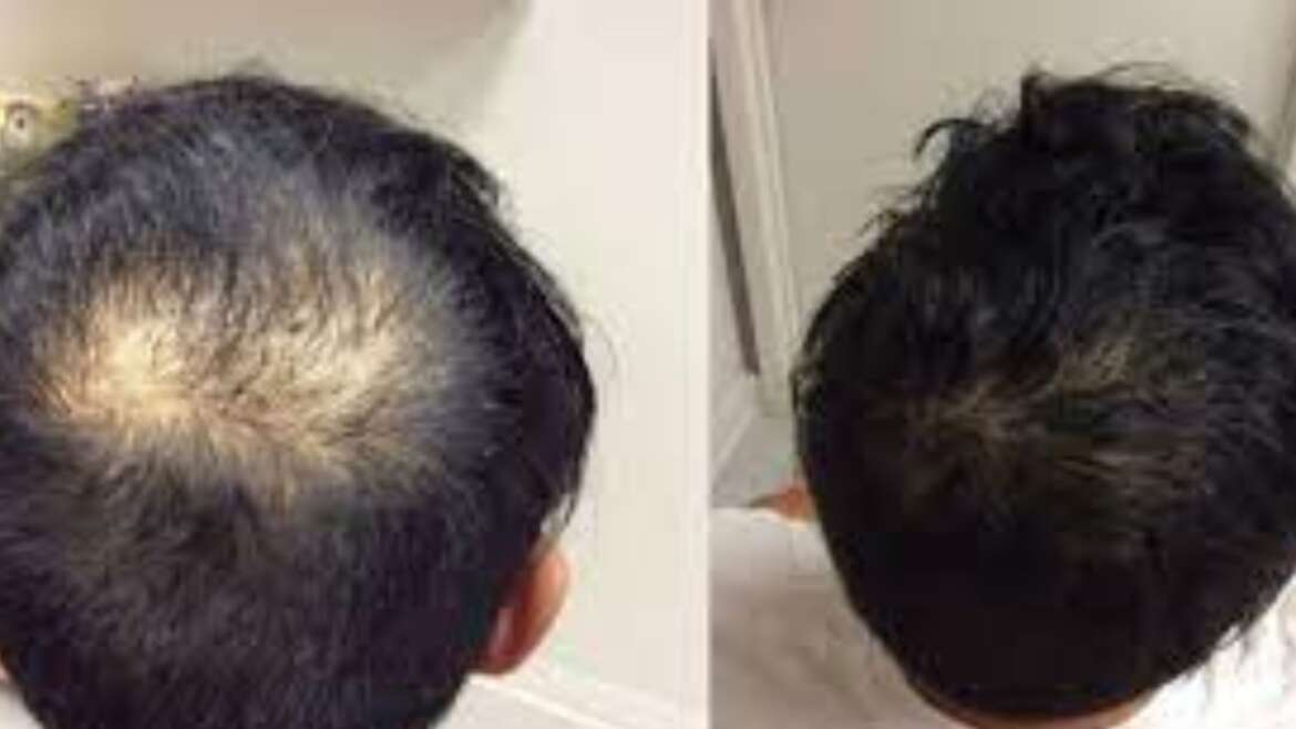 PRP Hair Loss Treatment