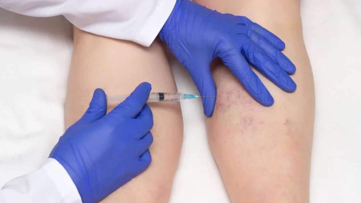 Sclerotherapy