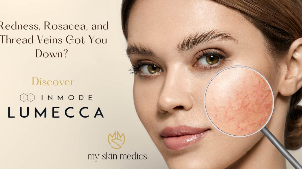 Redness, Rosacea, and Thread Veins Got You Down? Discover the Lumecca Solution at My Skin Medics